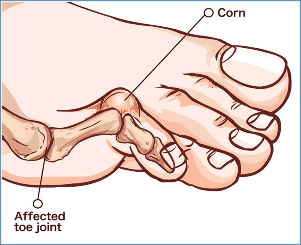 Hammertoe Yellowstone Surgery Center 9279