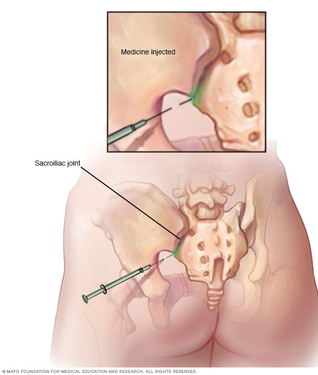 Umbilical Hernia Repair – Yellowstone Surgery Center